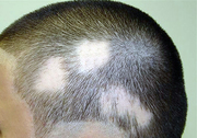 Лечение выпадения волос,  лечение всех форм облысения - без гормонов